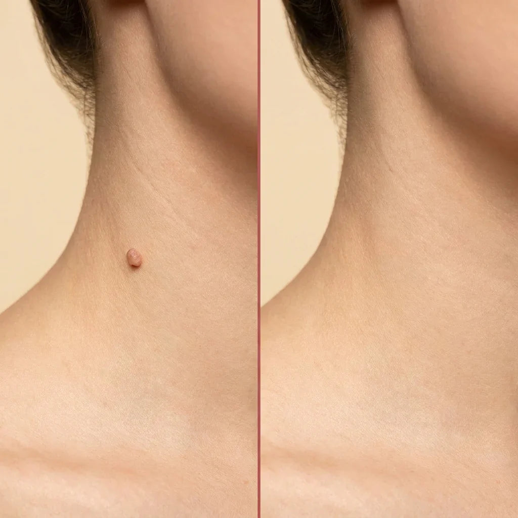 Velioraen™ ClearTag Microneedle Skin Tag Patch