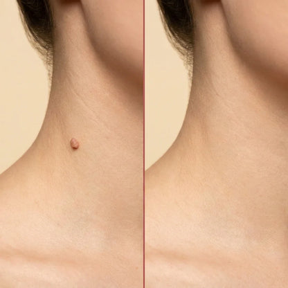 Velioraen™ ClearTag Microneedle Skin Tag Patch