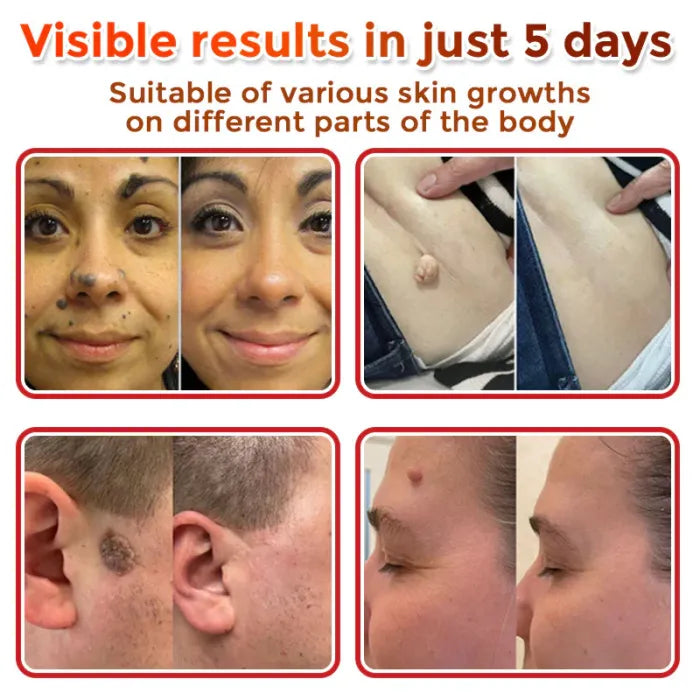 Velioraen™ ClearTag Microneedle Skin Tag Patch